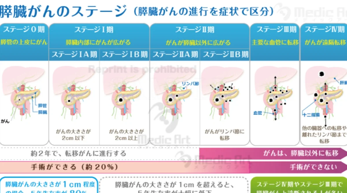 膵臓がんのステージ