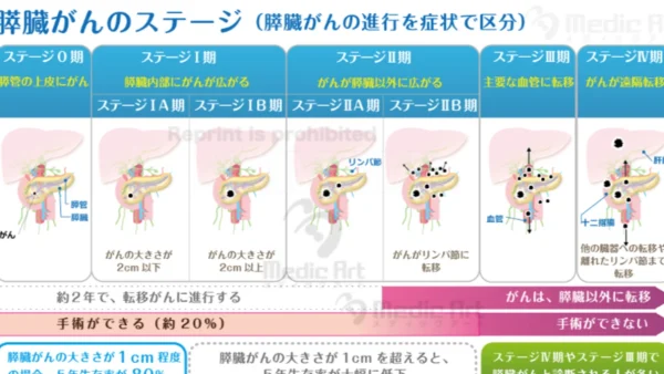 「膵臓がんのステージ」の説明